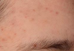 High-tech prevention of oily skin and hyper-seborrhoea