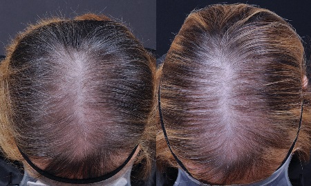 Study shows female alopecia efficacy