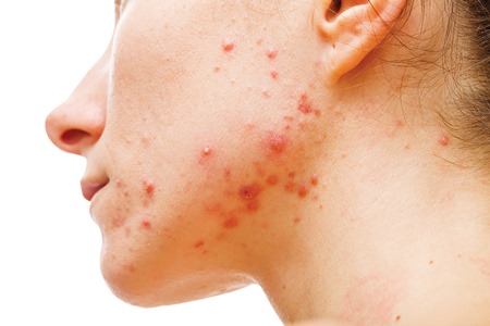 Anti-acne kit to aid formulators
