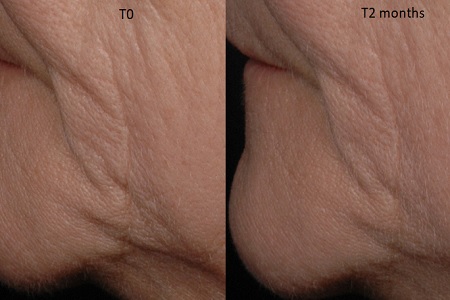 New active to help firm sagging skin