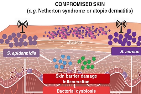 New discoveries on compromised skin microbiota