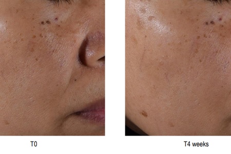 Efficacy on Asian skin type proven