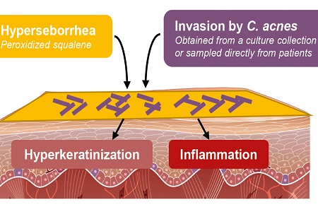 New 3D skin model mimicking acneic skin