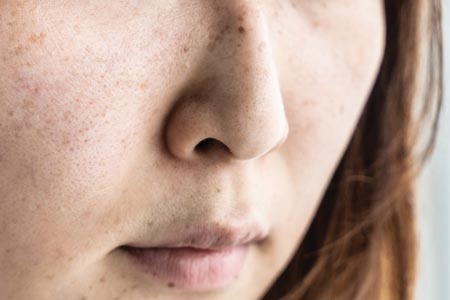 Tackling conspicuous  pores from start to finish